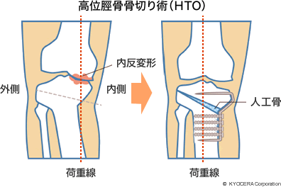 高位脛骨骨切り術（HTO）