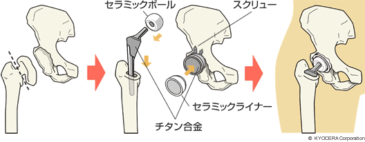 セラミック・オン・セラミックの人工股関節