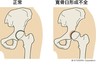 正常 寛骨臼形成不全