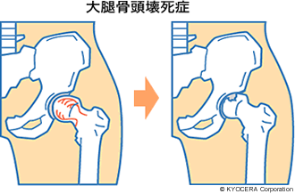 大腿骨頭壊死症