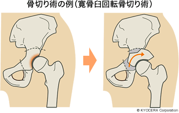 骨切り術の例（寛骨臼回転骨切り術）