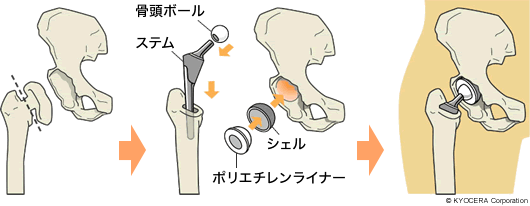 人工股関節