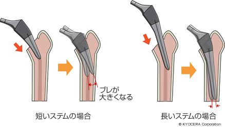 長いステムと短いステムの挿入時の相違点