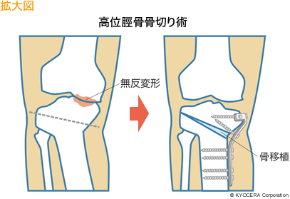 高位脛骨骨切り術