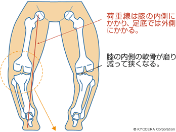 O脚の図