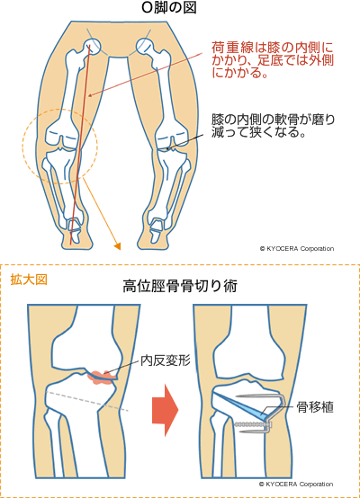 O脚の図、高位脛骨骨切り術の図