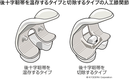 後十字靭帯を温存するタイプと切除するタイプの人工膝関節