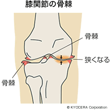 膝関節の骨棘