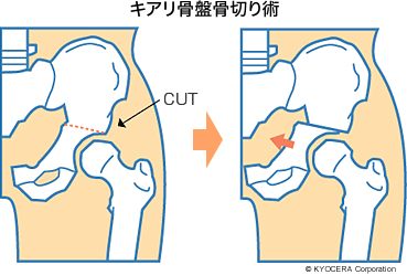 キアリ骨盤骨切り術