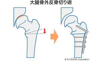 大腿骨外反骨切り術