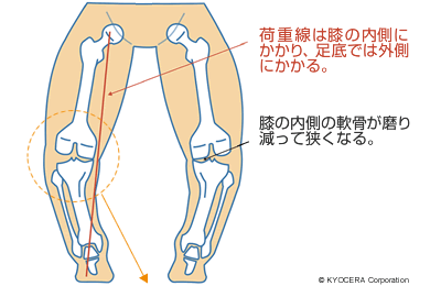 O脚の図