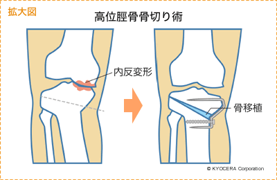 拡大図 高位脛骨骨切り術