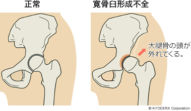 正常 寛骨臼形成不全