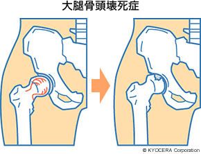 大腿骨頭壊死症