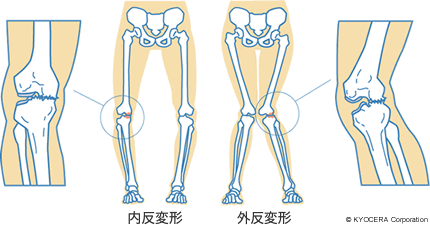 内反変形 外反変形