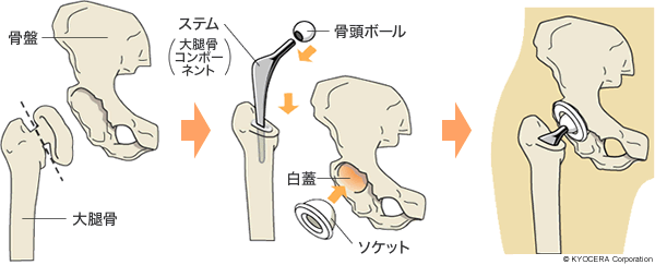 セメント固定人工股関節の例