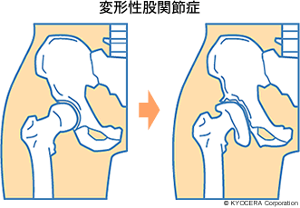 変形性股関節症