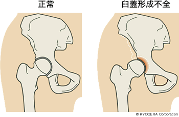 正常 臼蓋形成不全