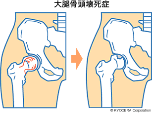 大腿骨頭壊死症