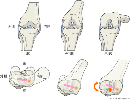 大腿骨の内側を中心に回旋しながら徐々に後方にずれていくイメージ図