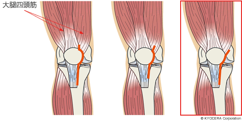 大腿四頭筋