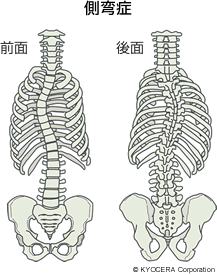 側弯症