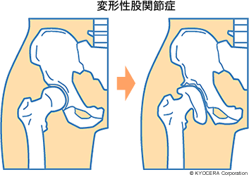 変形性股関節症