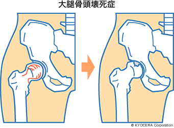 大腿骨頭壊死症