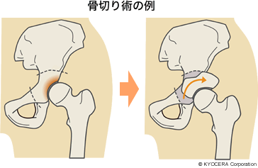 骨切り術の例