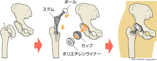 人工股関節