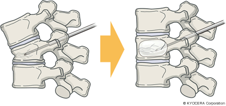椎体形成術