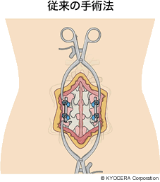 従来の手術法