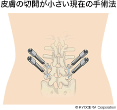 皮膚の切開が小さい現在の手術法