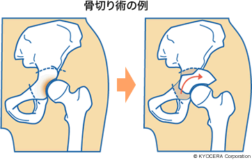 骨切り術の例