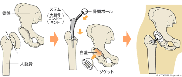 セメント固定人工股関節の例