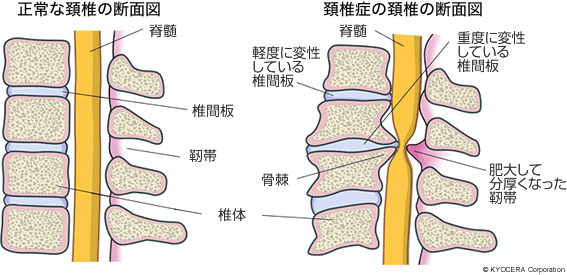 正常な頚椎の断面図 頚椎症の頚椎の断面図