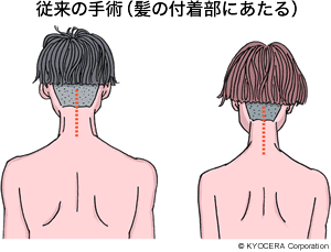 従来の手術（髪の付着部にあたる）