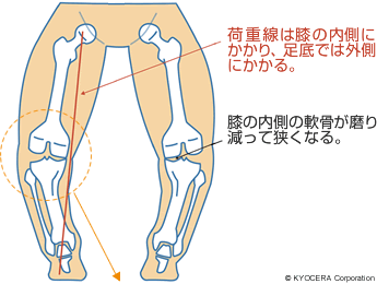 O脚の図