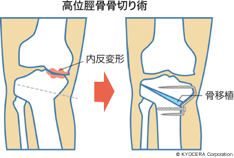 高位脛骨骨切り術