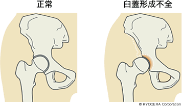 正常 臼蓋形成不全症