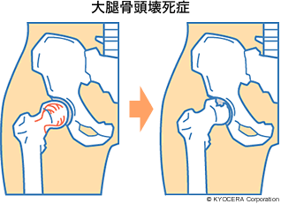 大腿骨頭壊死症