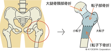 大腿骨頸部骨折