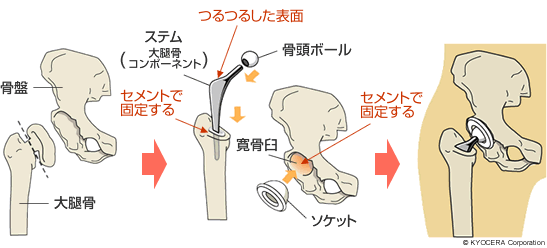 セメントタイプの人工股関節