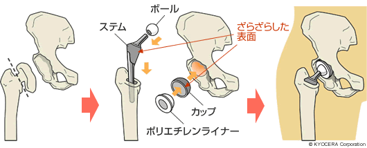 セメントレスタイプの人工股関節