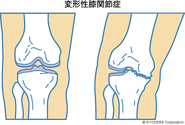 変形性膝関節症