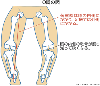 O脚の図