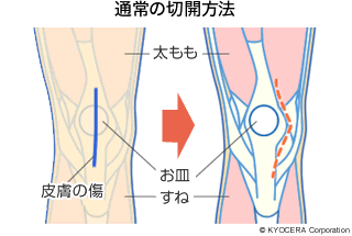 通常の切開方法