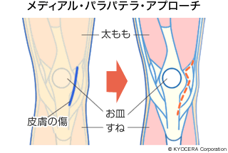 メディアル・パラパテラ・アプローチ