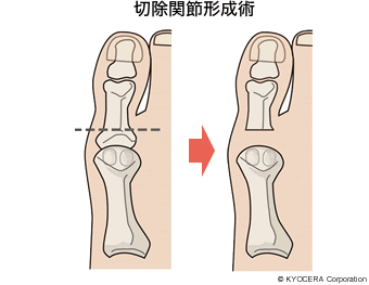 切除関節形成術