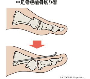 中足骨短縮骨切り術